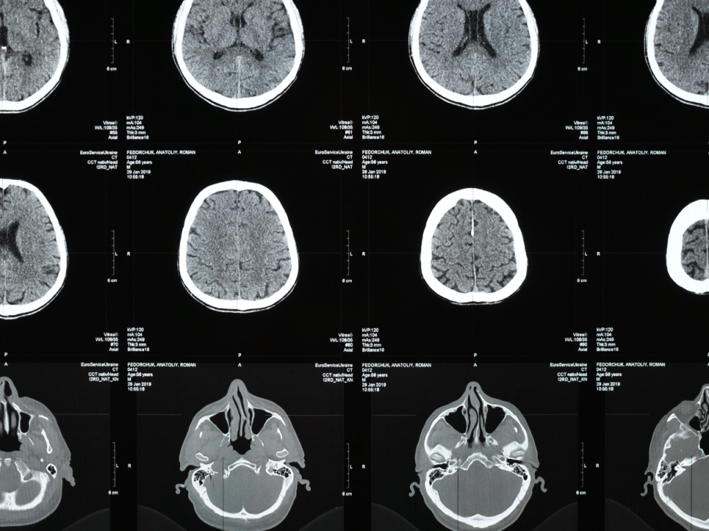 beneficios-resonancia-magnetica-cd-juarez-diagnostico-preciso