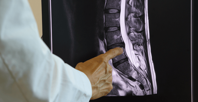 dolor-lumbar-resonancia-magnetica-columna-lumbar